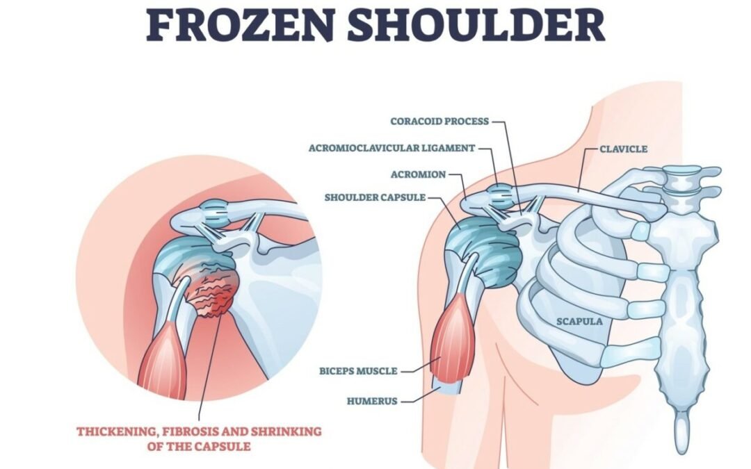 The Complete Guide to Frozen Shoulder | No BS