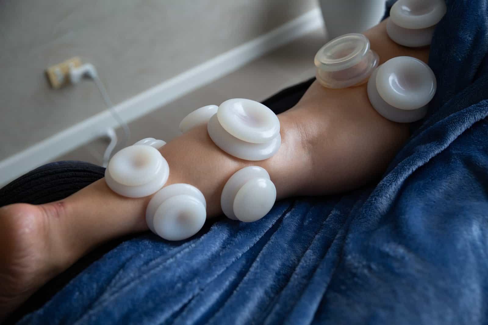 Cupping applied to the skin to create gentle tissue lift during treatment