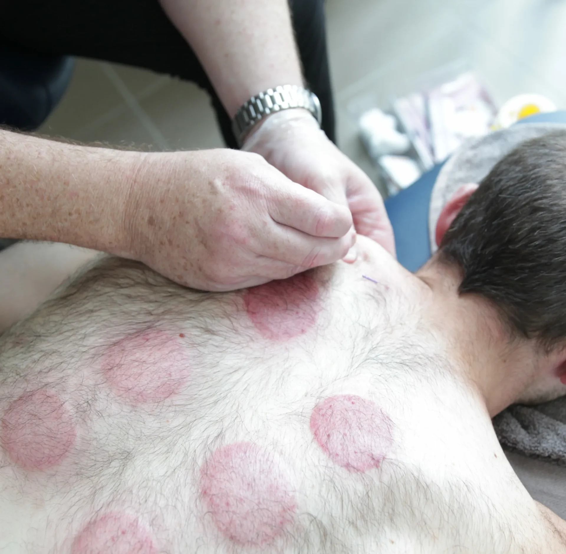 What dry needling may feel like during and after treatment